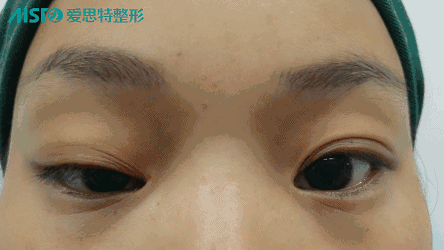 【美眼案例】你一定不知道刚割完的双眼皮是这样!
